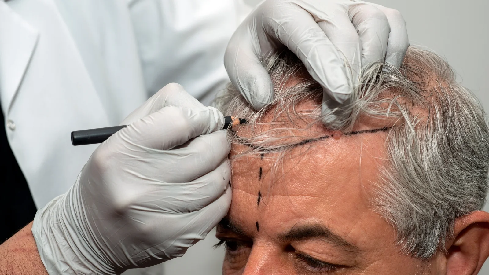 Why Do Men Go to Turkey for Hair Transplant Procedures?