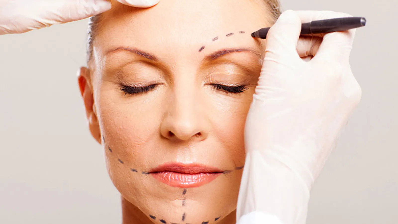 Facelift