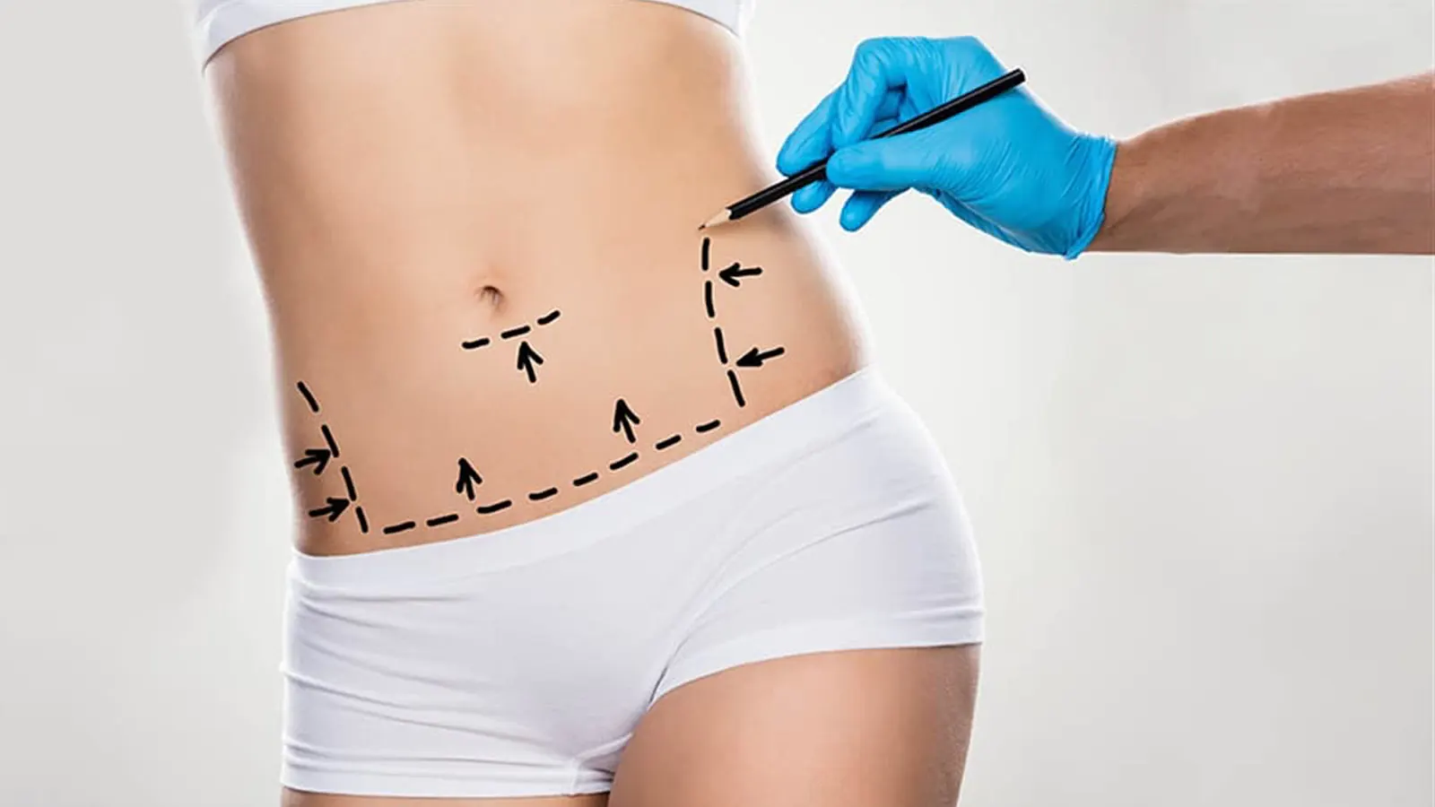 Tummy Tuck