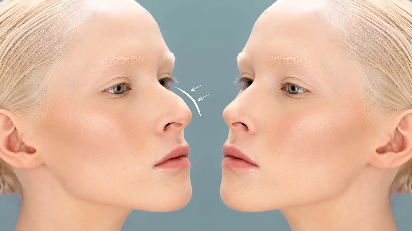 Rhinoplasty