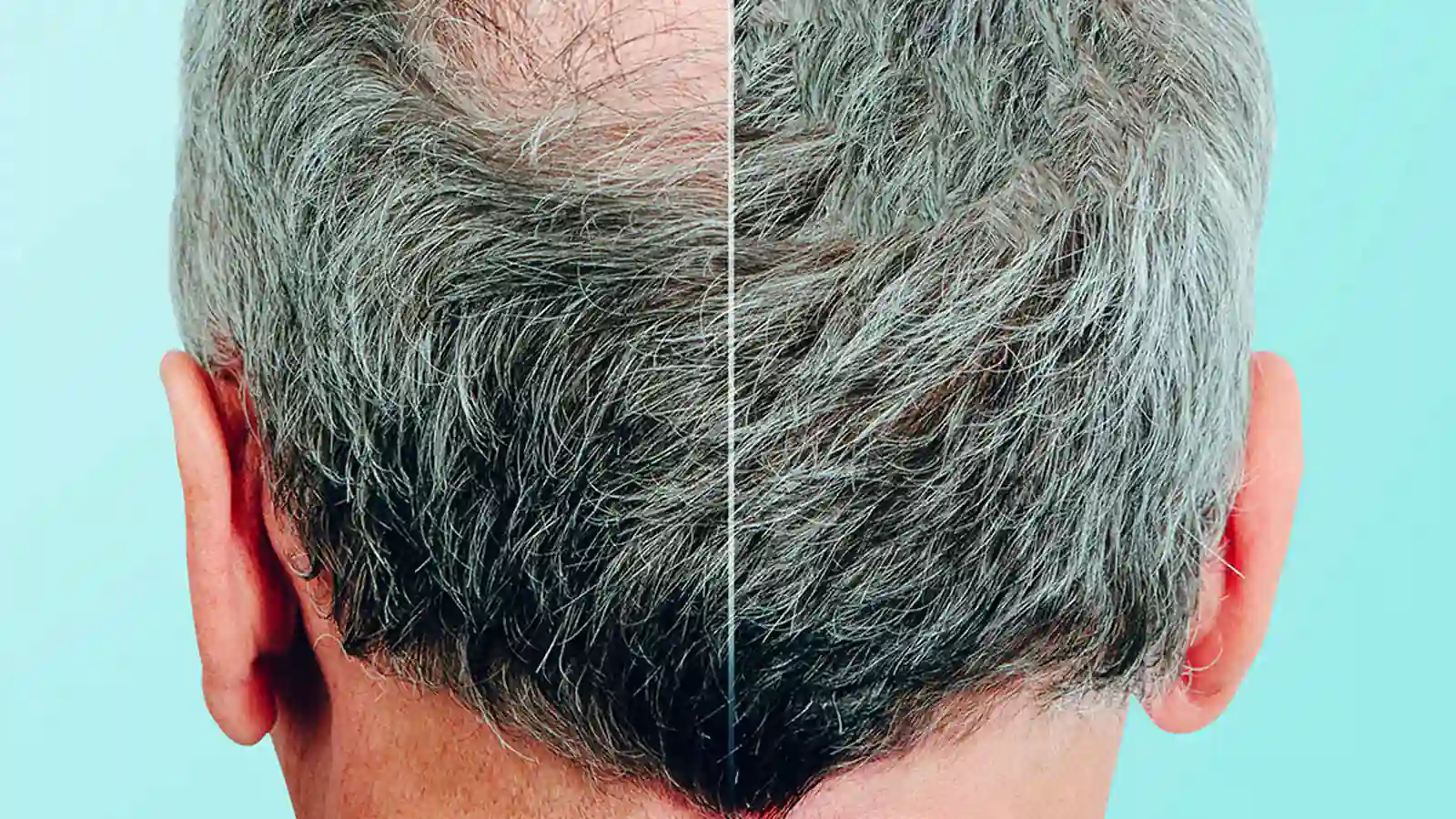 Hair Transplant