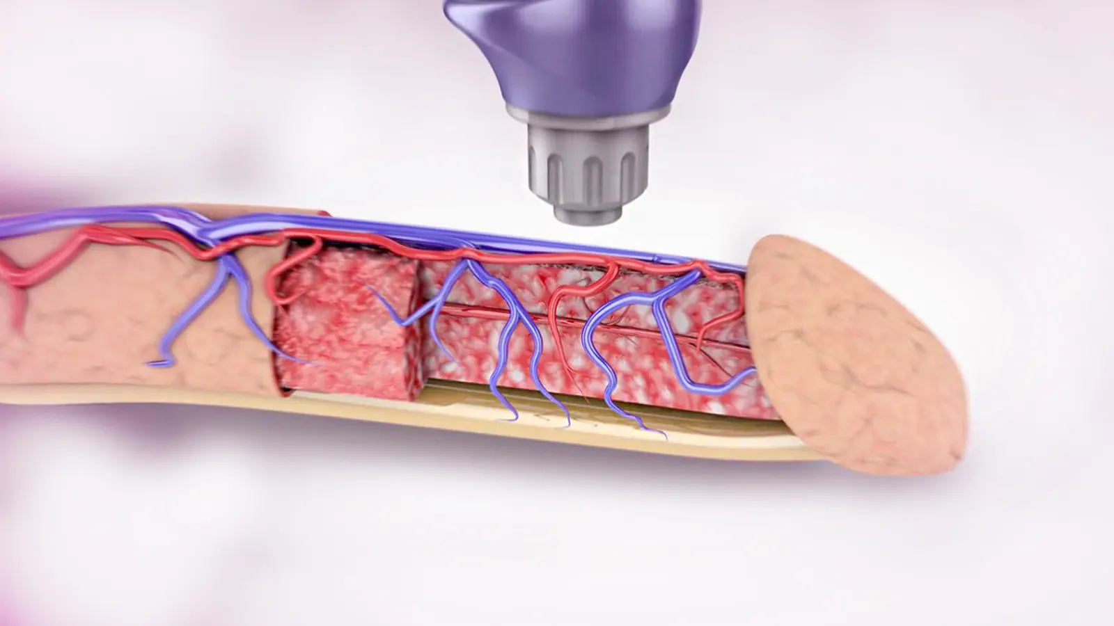 Penis Enlargement Surgery