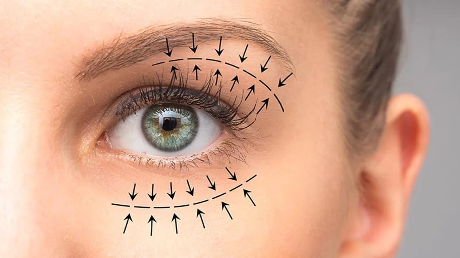 Blepharoplasty