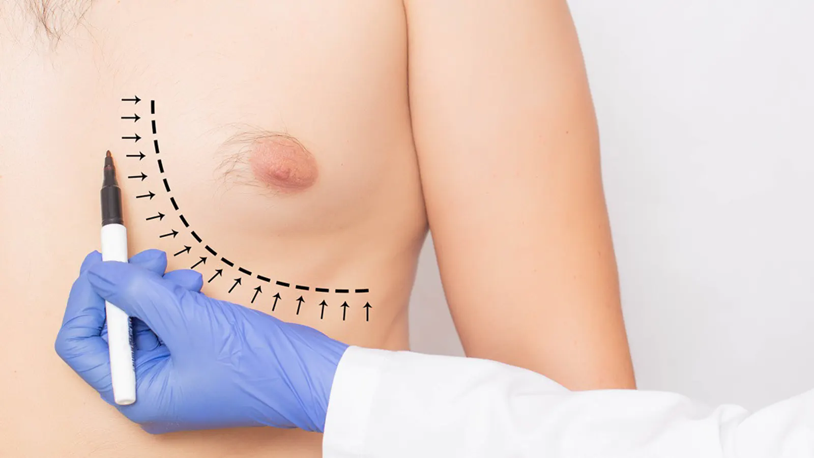 Gynecomastia Surgery