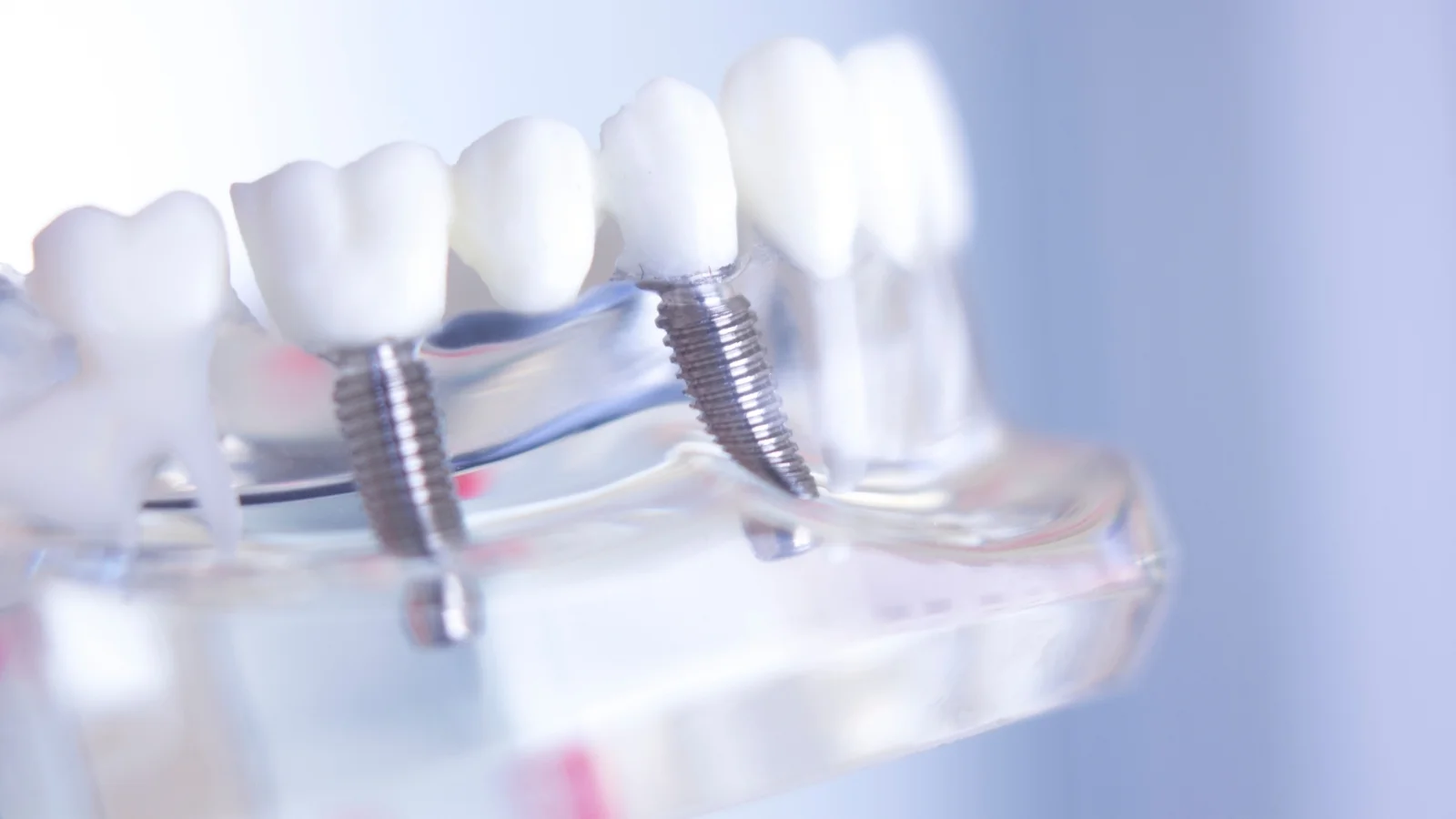 All on 4 Dental Implants