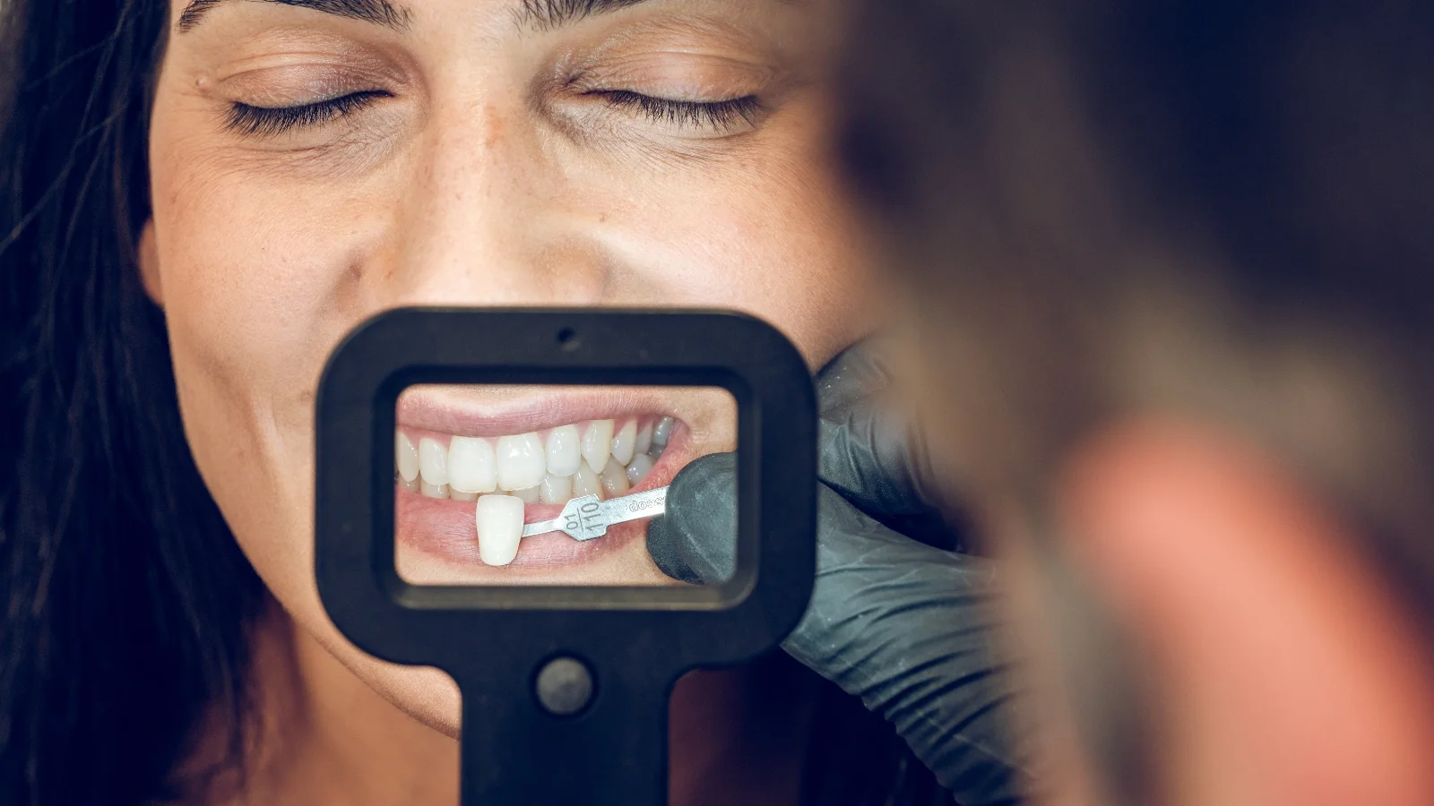 Dental Veneers