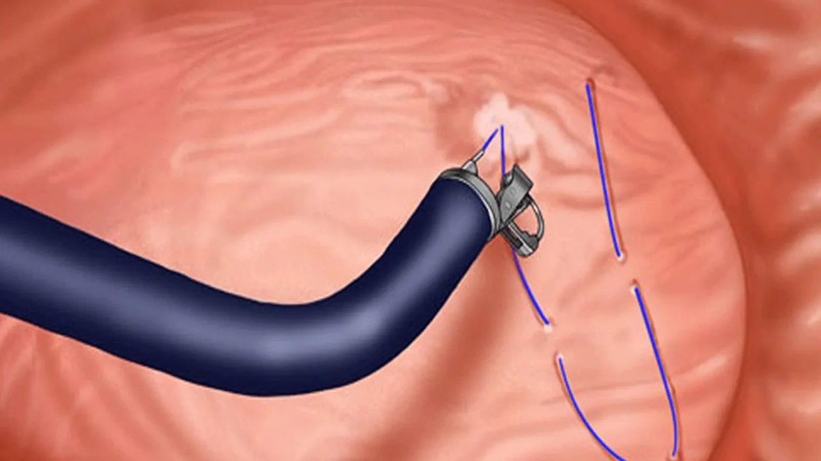 Endoscopic Sleeve Gastroplasty