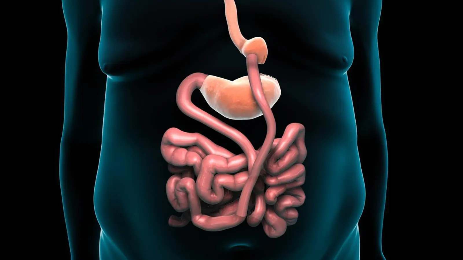 Gastric Bypass
