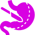 Gastric Sleeve