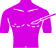 Gynecomastia
